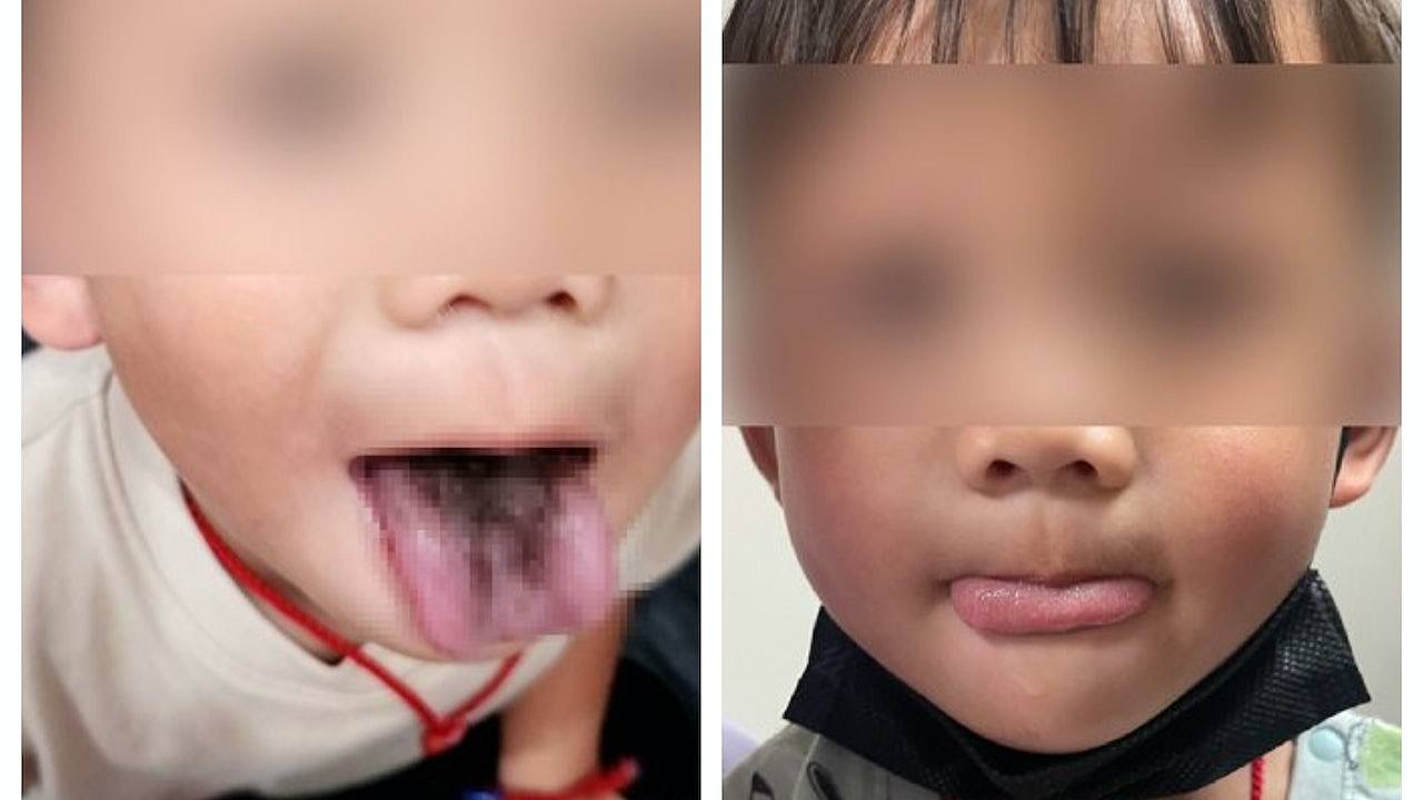 4岁男童舌头长黑毛！不痛无异味，或与长期使用抗生素有关（组图） - 1
