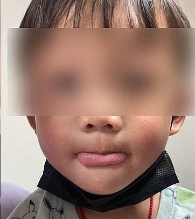 4岁男童舌头长黑毛！不痛无异味，或与长期使用抗生素有关（组图） - 3