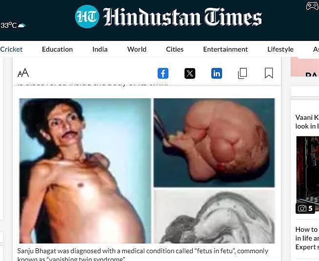 男子“怀孕36年”取出4公斤死胎！医生：已有头发生殖器（组图） - 3