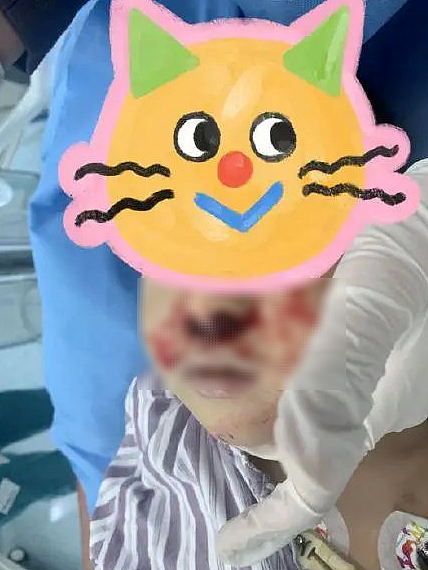 3岁男童休克，双侧鼻腔糜烂，血流不止！医生一问，竟是奶奶把头发塞娃鼻腔（组图） - 1