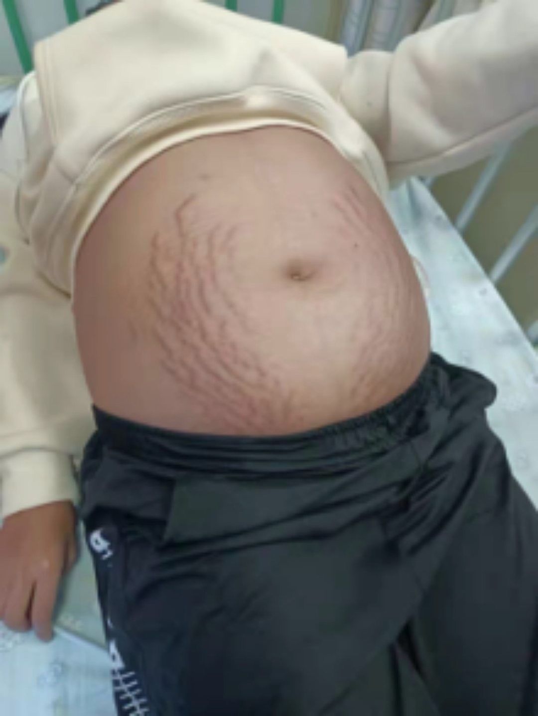 13岁初中女生肚子隆起爬满“妊娠纹”，照完CT，妈妈和医生当场吓懵（组图） - 2