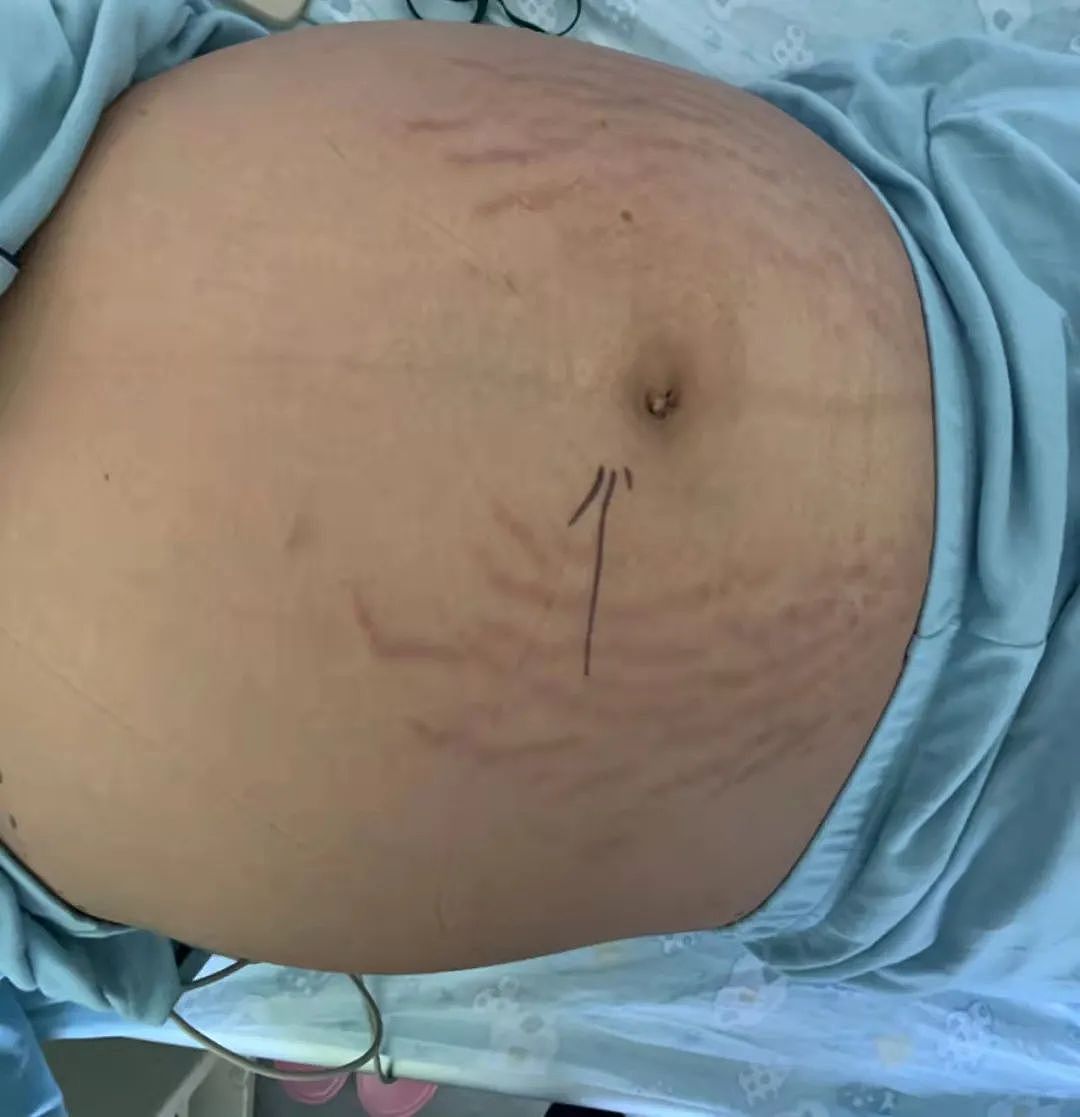 13岁初中女生肚子隆起爬满“妊娠纹”，照完CT，妈妈和医生当场吓懵（组图） - 8