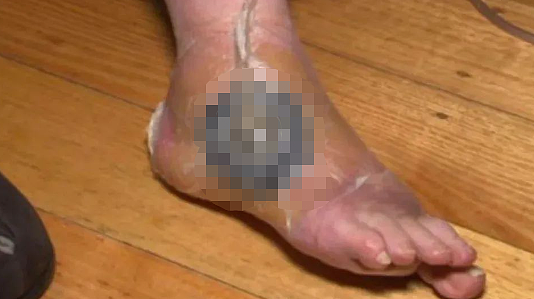 可怕细菌肆虐墨尔本！66岁祖母感染后脚背溃烂面临截肢！“痛到生不如死”（组图） - 2