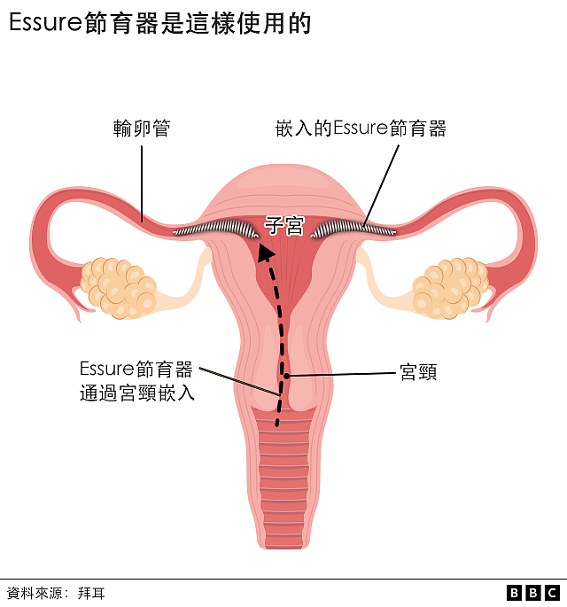 Essure节育器副作用巨大，澳洲千名女性起诉制药巨头拜耳（组图） - 2