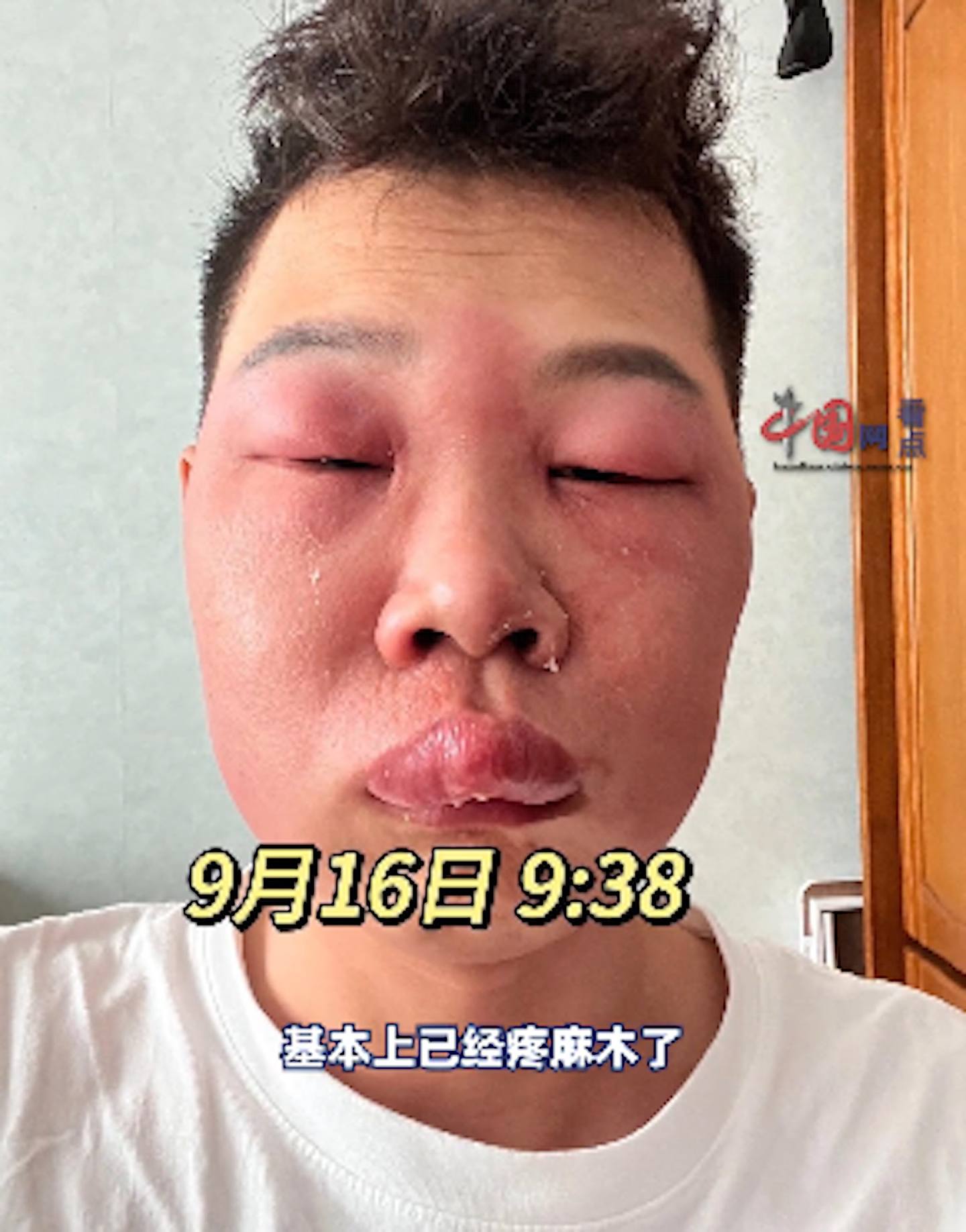 狂在鼻孔里“挖呀挖“ ，北京男子面部肿成“猪“模样（组图） - 5