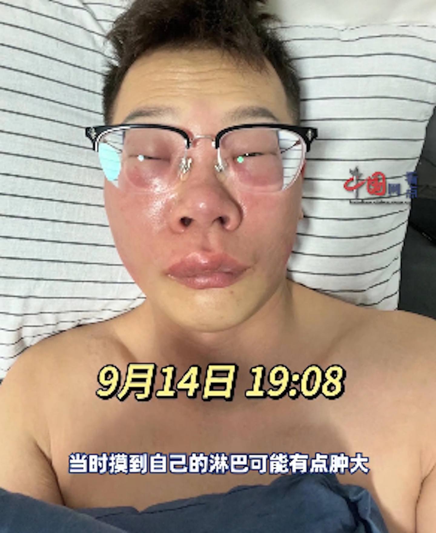 狂在鼻孔里“挖呀挖“ ，北京男子面部肿成“猪“模样（组图） - 2