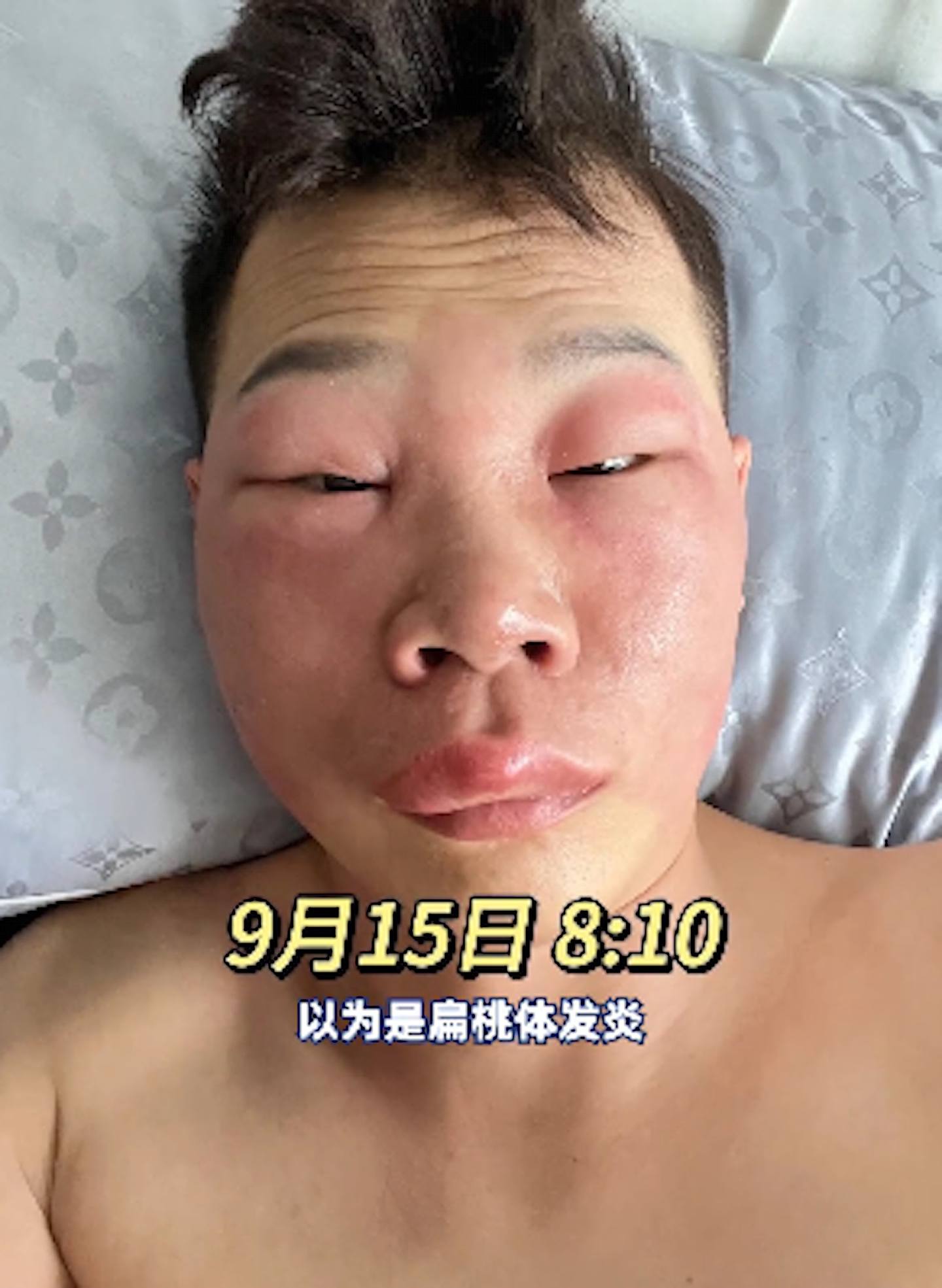 狂在鼻孔里“挖呀挖“ ，北京男子面部肿成“猪“模样（组图） - 3