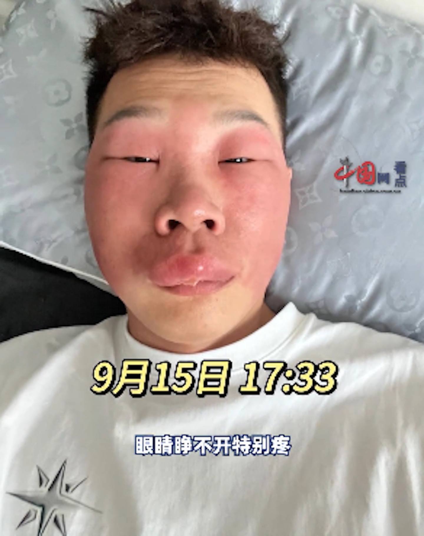 狂在鼻孔里“挖呀挖“ ，北京男子面部肿成“猪“模样（组图） - 4