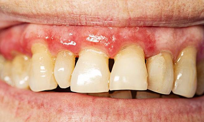 【健康】掉牙和寿命有关？60岁后，牙齿剩多少算正常，看看您达标了吗（组图） - 4