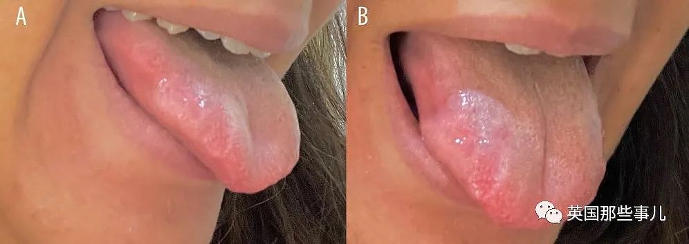 孕妇吃饭时咬到嘴唇，竟长成肿瘤长达4个月？医生：过于罕见！（组图） - 8