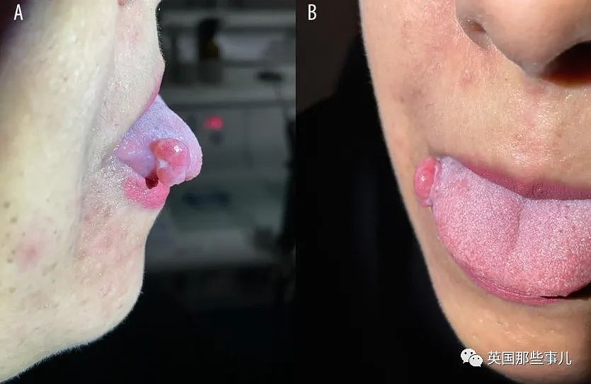 孕妇吃饭时咬到嘴唇，竟长成肿瘤长达4个月？医生：过于罕见！（组图） - 4