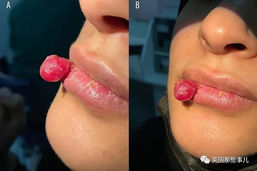 孕妇吃饭时咬到嘴唇，竟长成肿瘤长达4个月？医生：过于罕见！（组图） - 3