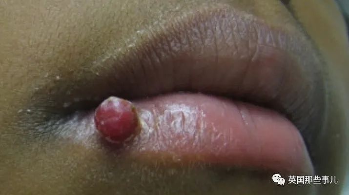 孕妇吃饭时咬到嘴唇，竟长成肿瘤长达4个月？医生：过于罕见！（组图） - 6