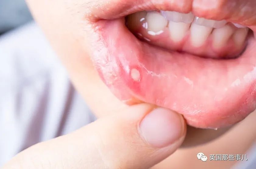 孕妇吃饭时咬到嘴唇，竟长成肿瘤长达4个月？医生：过于罕见！（组图） - 1