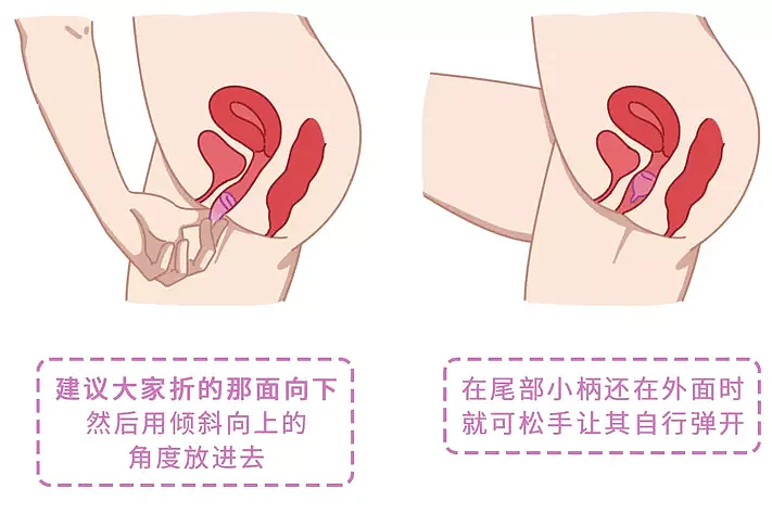 【健康】为啥国外女性爱用卫生棉条，而中国女性喜欢用卫生巾？哪个更好？（组图） - 5