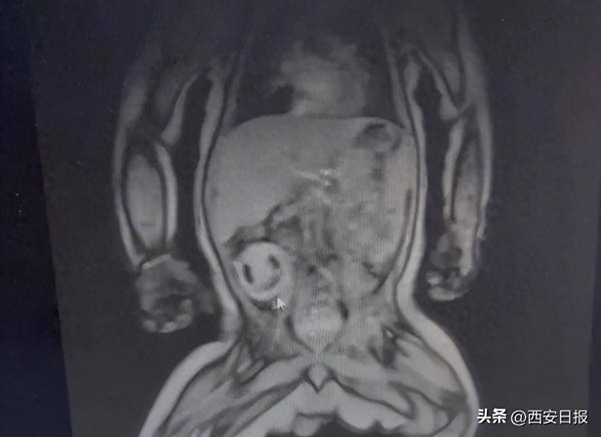 4月大男婴蛋蛋坏死，一查胎儿“寄生睪丸里”，医揭罕见病况（组图） - 1