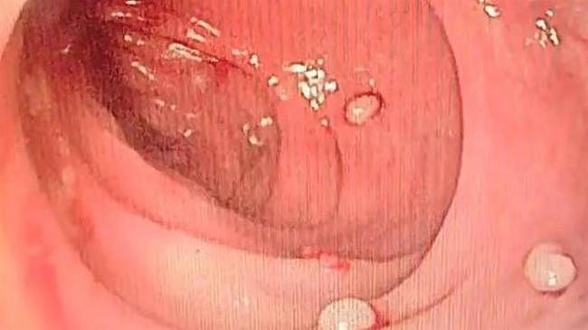 14岁男孩疯狂腹泻2个月，照肠镜惊见“20颗珍珠”，医揭恐怖后果（组图） - 1