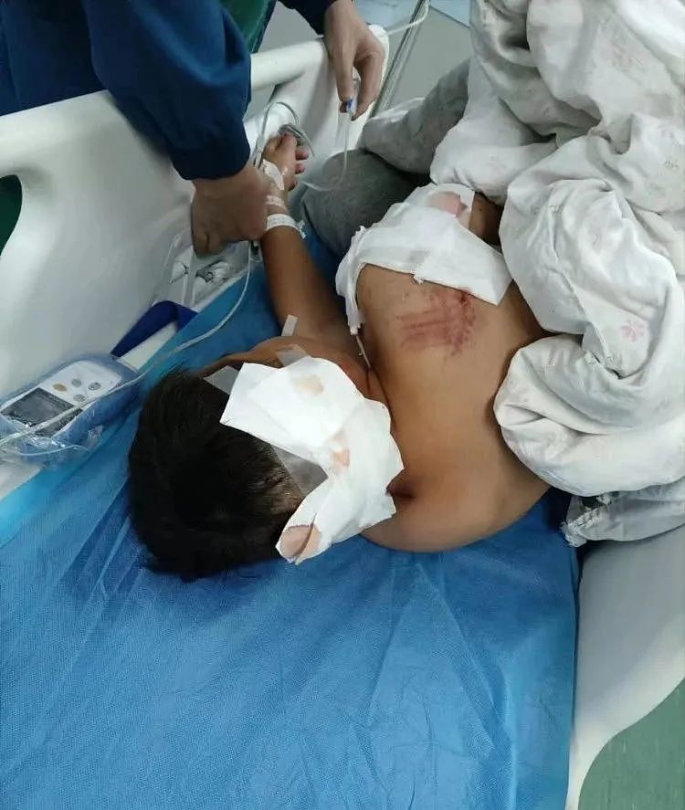 中国10岁男童遭阿拉斯加犬咬伤，仍在ICU内抢救（组图） - 1