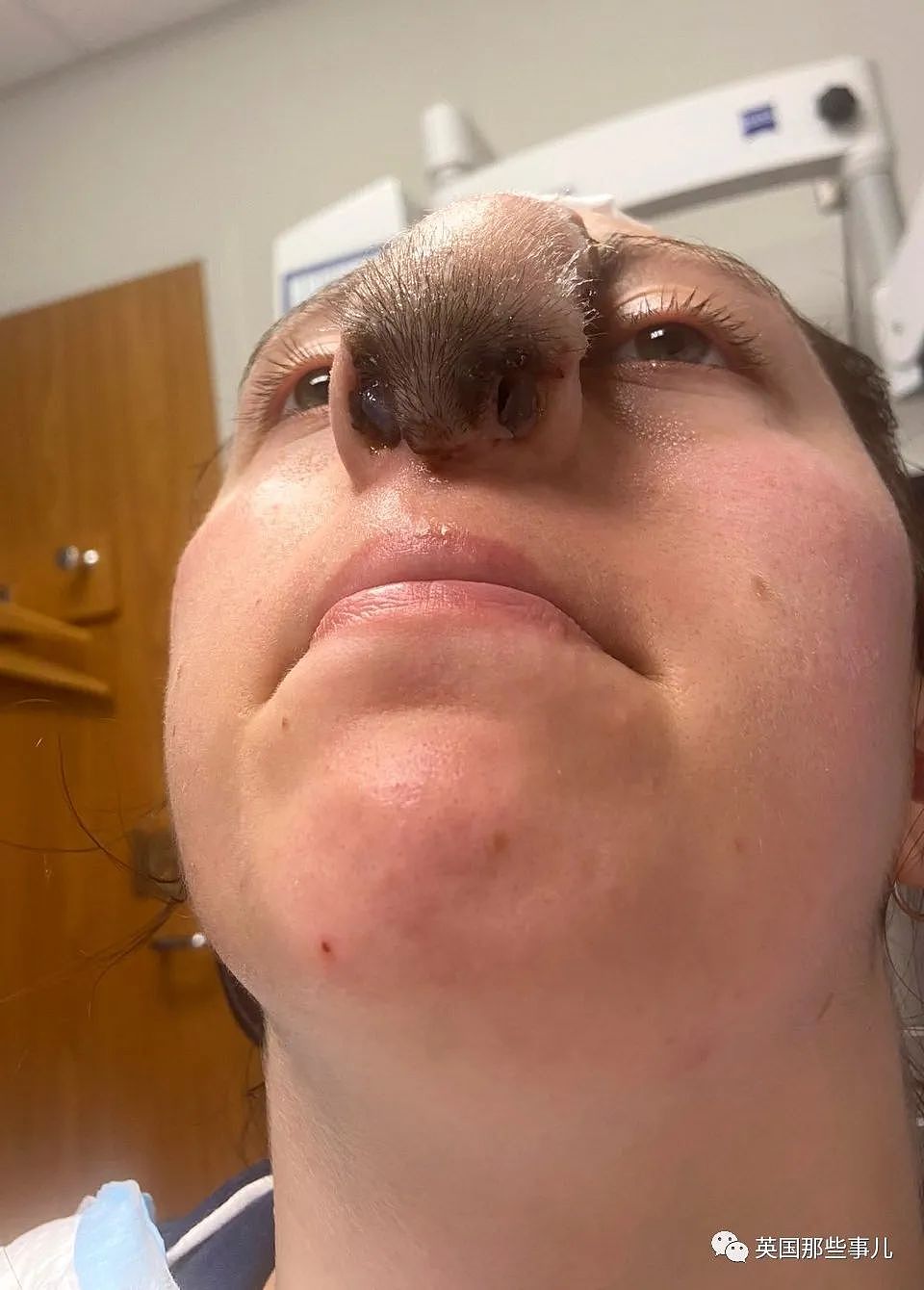 女孩遭家犬咬掉鼻子，移植头皮做手术后，鼻尖竟长出了“头发”？！（组图） - 11