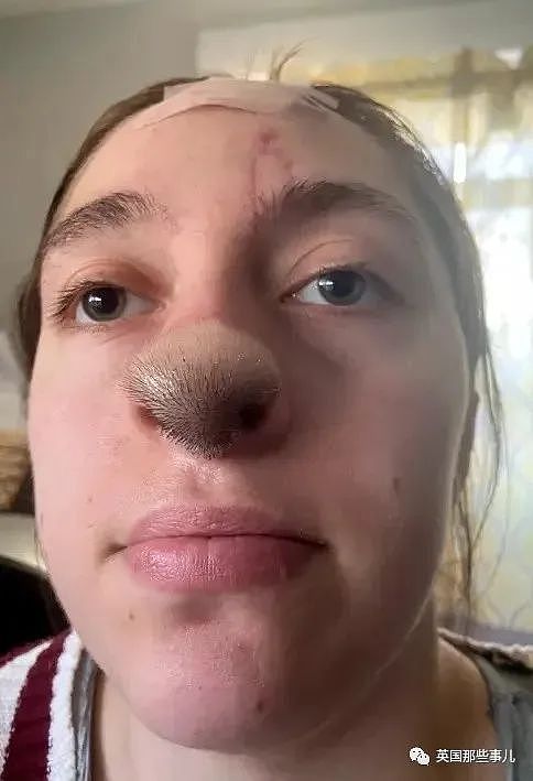 女孩遭家犬咬掉鼻子，移植头皮做手术后，鼻尖竟长出了“头发”？！（组图） - 12