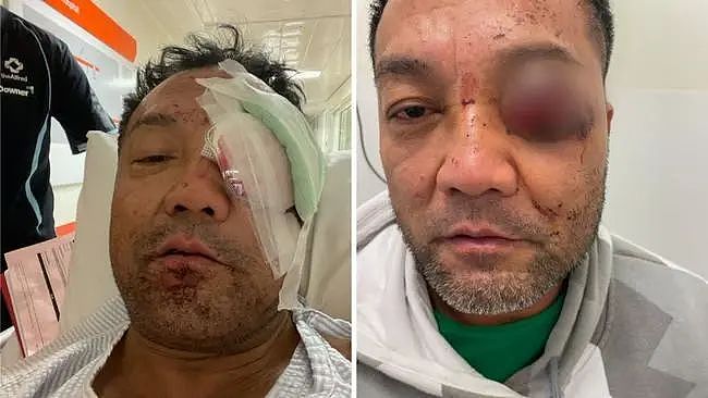 慎入！墨尔本亚裔男子工作遇意外爆炸，眼球“掉出”眼睛致失明，保险公司竟告知工作单位不需负责（组图） - 2