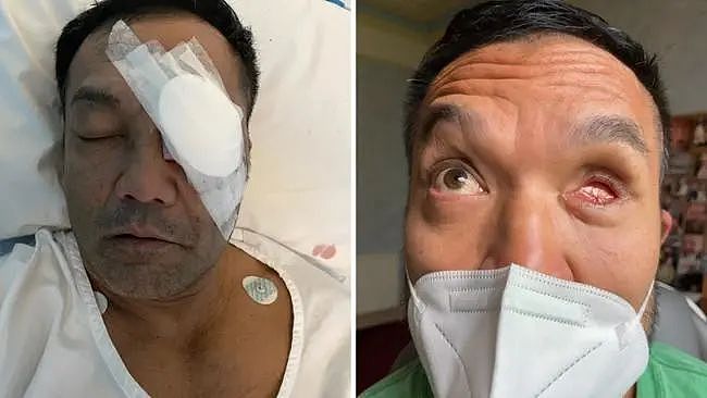 慎入！墨尔本亚裔男子工作遇意外爆炸，眼球“掉出”眼睛致失明，保险公司竟告知工作单位不需负责（组图） - 3