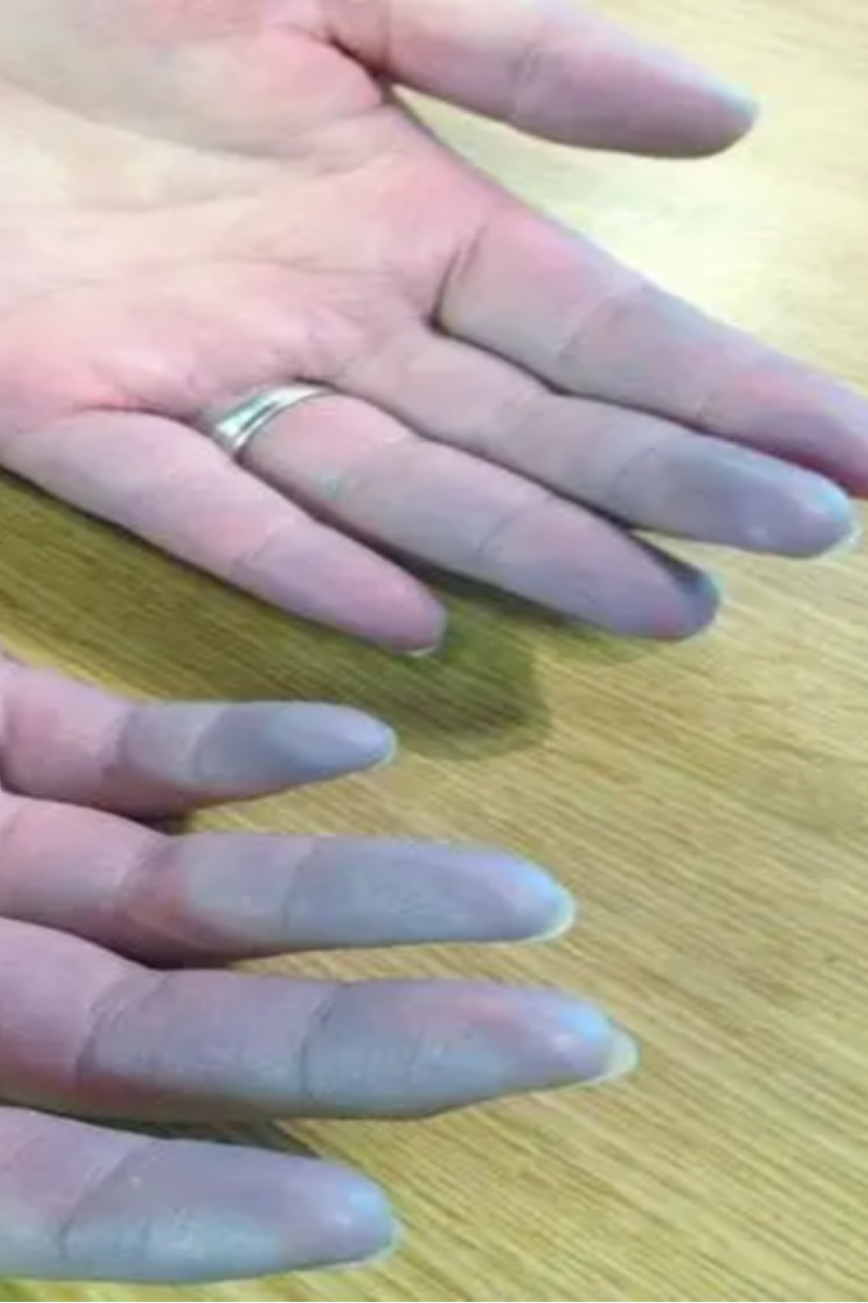 手指变白、变紫…天冷后有这些情况，可能是疾病前兆！女性更容易中招（组图） - 3