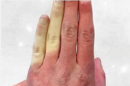 手指变白、变紫…天冷后有这些情况，可能是疾病前兆！女性更容易中招（组图） - 2