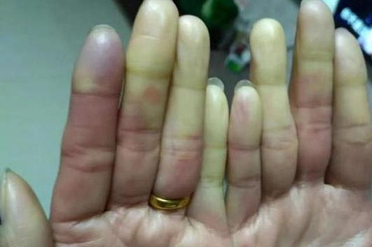 手指变白、变紫…天冷后有这些情况，可能是疾病前兆！女性更容易中招（组图） - 1