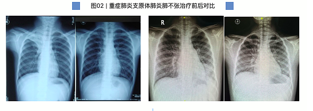 一天67例“洗肺”！7岁男童肺部实变，紧急提醒……（组图） - 5