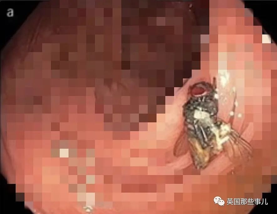 美国大爷的肠道中竟有一只完整苍蝇？医生：误食苍蝇卵在肚里孵出长大的（组图） - 2