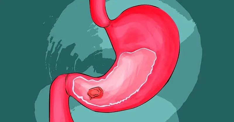 胃病变成“胃癌”前，曾用5个症状提醒你（组图） - 5