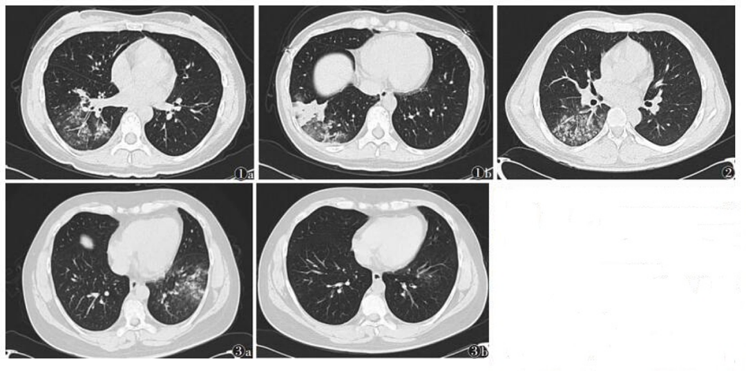 “白肺”焦虑仍在蔓延，90万病例研究：儿童CT检查可能致血癌（组图） - 13