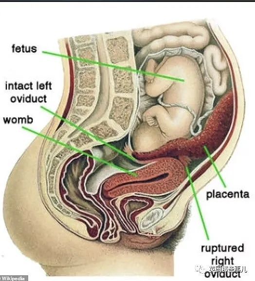 女子胃疼10多天不见好转，检查才发现大肠附近有个胎儿，已经23周大（组图） - 4