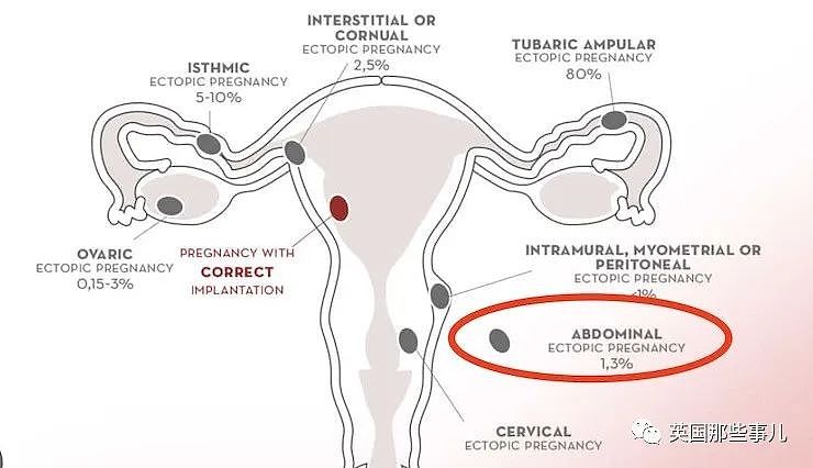 女子胃疼10多天不见好转，检查才发现大肠附近有个胎儿，已经23周大（组图） - 3