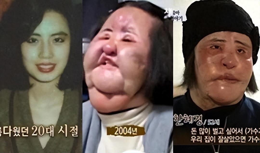 整容上瘾的韩女星：把脸整成电风扇，自行注射食用油，最后怎样了（组图） - 1