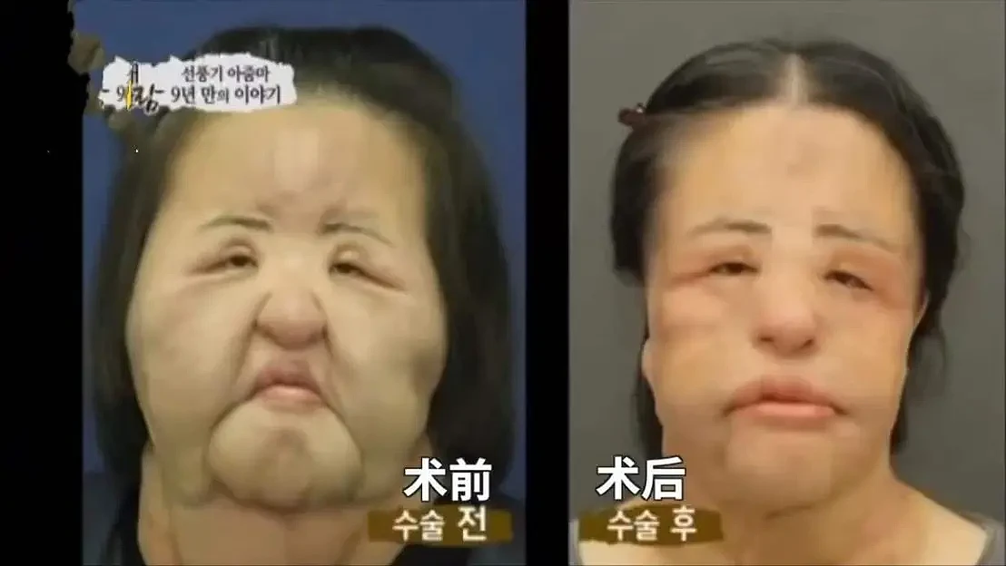 整容上瘾的韩女星：把脸整成电风扇，自行注射食用油，最后怎样了（组图） - 6