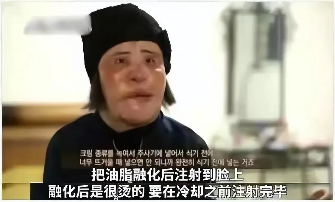 整容上瘾的韩女星：把脸整成电风扇，自行注射食用油，最后怎样了（组图） - 21