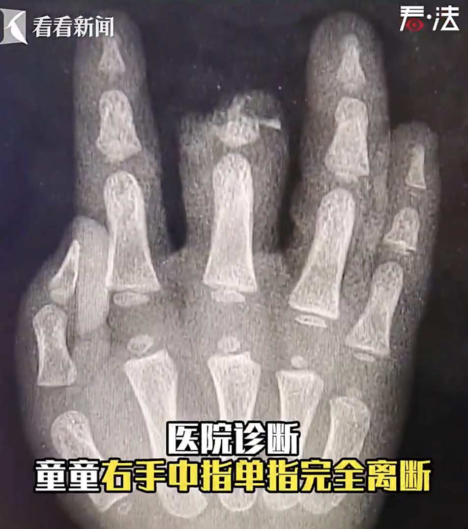 血压高了！19个月幼童被扶梯夹断手指，上海一商场惨被家长划分主要责任并索赔5.7万，法院这样判...（视频/组图） - 11