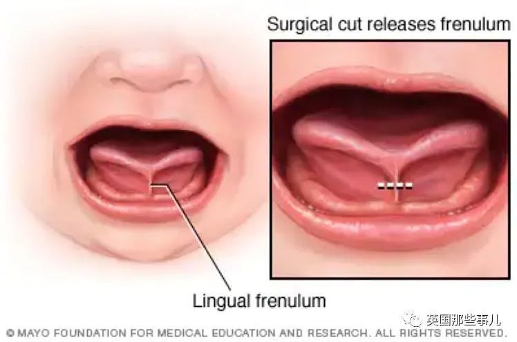 美国黑心牙医忽悠父母给婴儿“切舌头”，慌称方便母乳，实则谋财伤人（组图） - 1