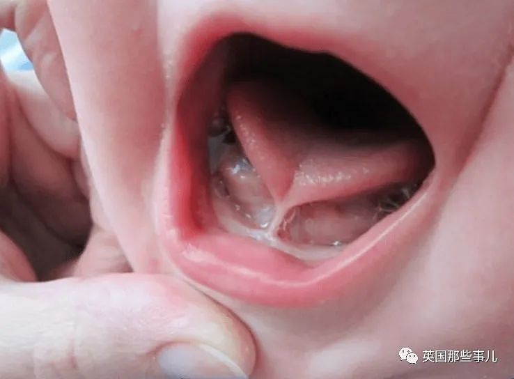 美国黑心牙医忽悠父母给婴儿“切舌头”，慌称方便母乳，实则谋财伤人（组图） - 2