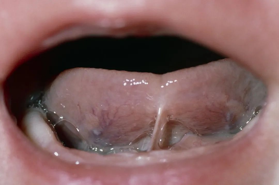 美国妈妈流行给婴儿舌头划一刀，还说这能“治百病”（组图） - 1