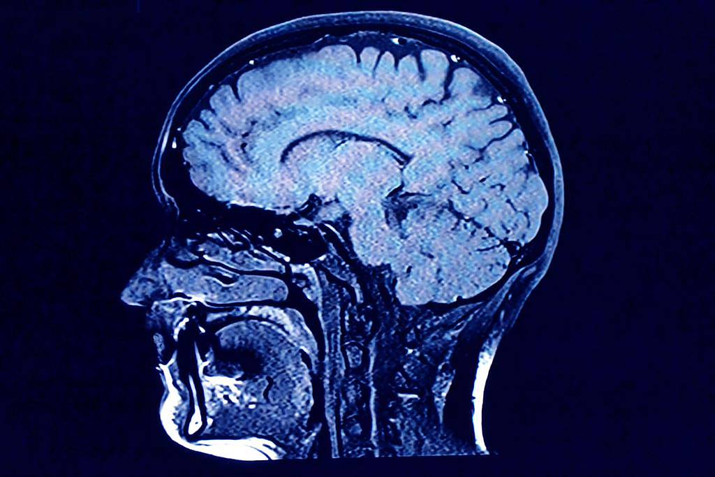 《自然》最新研究： 感染新冠， 脑部衰老20年！ 长期感染新冠， 恐导致老年痴呆（组图） - 2