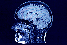 《自然》最新研究： 感染新冠， 脑部衰老20年！ 长期感染新冠， 恐导致老年痴呆（组图）