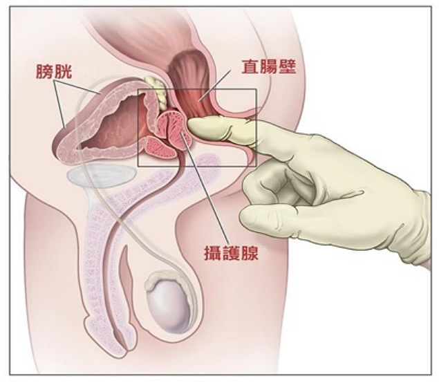 查尔斯前列腺手术细节公开！中国200多万男性患前列腺肥大（组图） - 22
