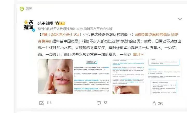 一加班就发作，杭州20多岁姑娘嘴上反复起水疱 ，竟查出这种终身潜伏的病毒（组图） - 2