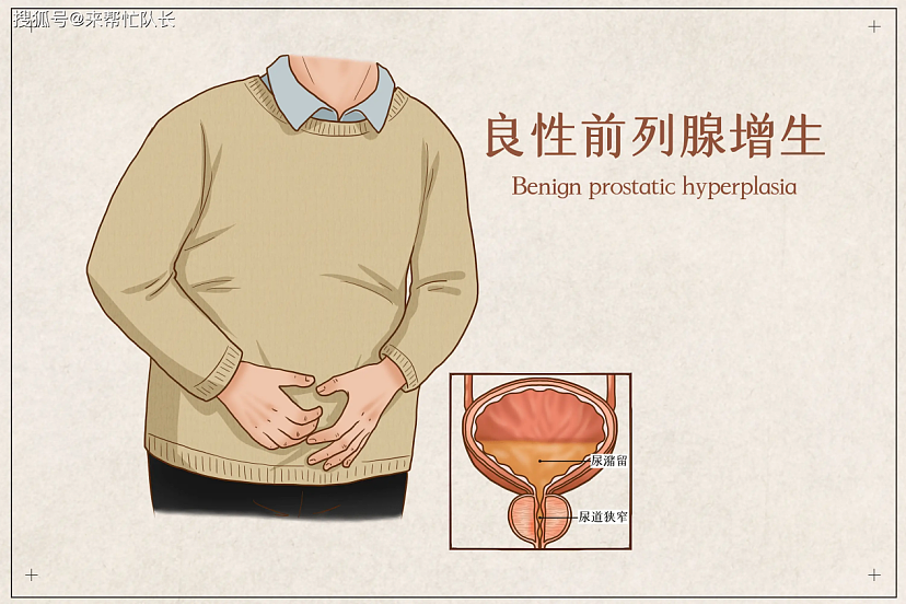 查尔斯前列腺手术细节公开！中国200多万男性患前列腺肥大（组图） - 12
