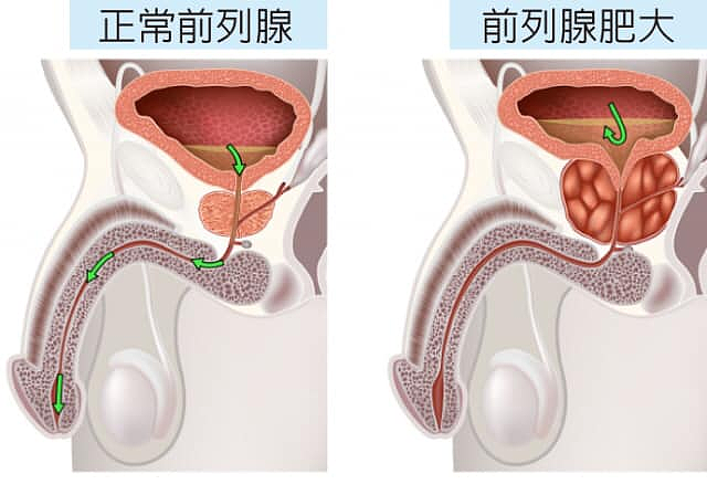 查尔斯前列腺手术细节公开！中国200多万男性患前列腺肥大（组图） - 4