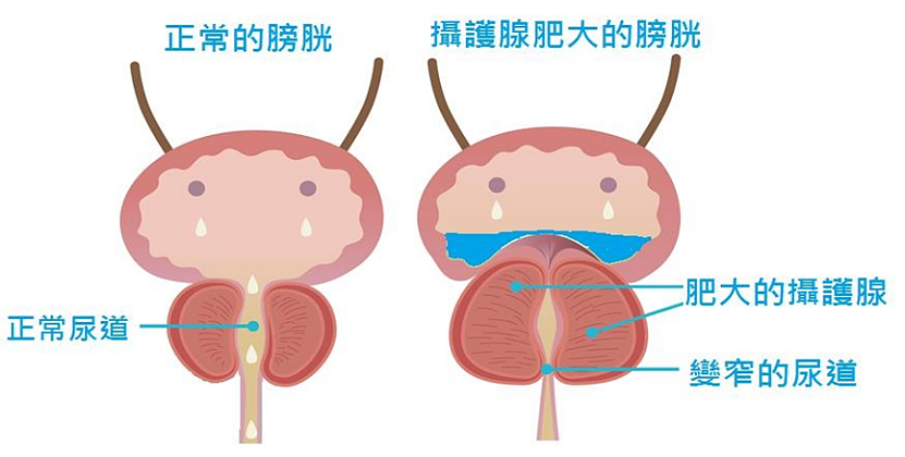 查尔斯前列腺手术细节公开！中国200多万男性患前列腺肥大（组图） - 19