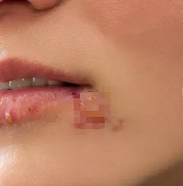 一加班就发作，杭州20多岁姑娘嘴上反复起水疱 ，竟查出这种终身潜伏的病毒（组图） - 3
